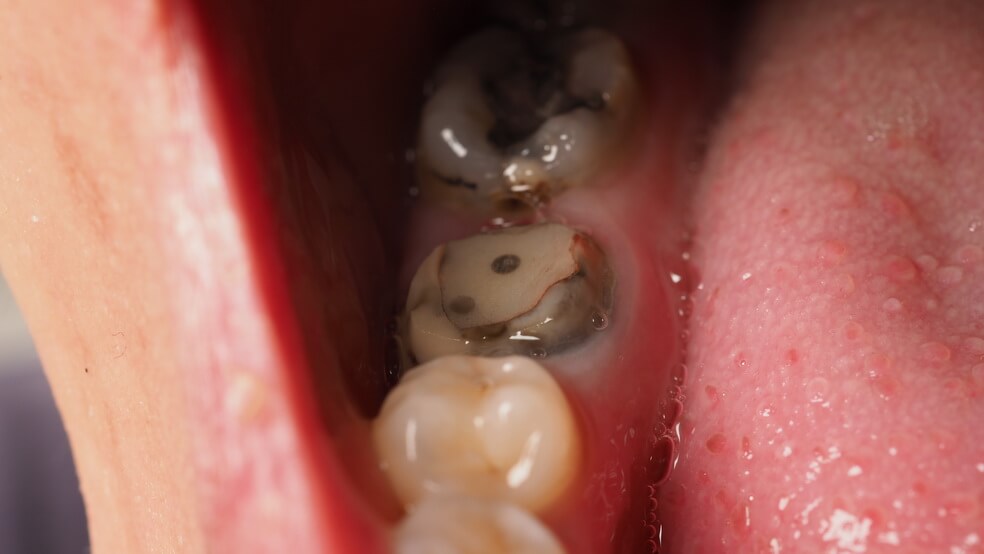 โรคฟันผุ สาเหตของการเกิดโรคฟันผุ